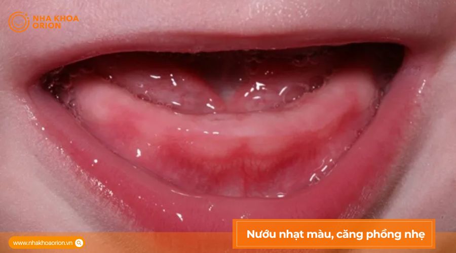 Nướu nhạt m&agrave;u, căng phồng nhẹ