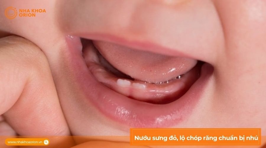 Nướu sưng đỏ, lộ ch&oacute;p răng chuẩn bị nh&uacute;