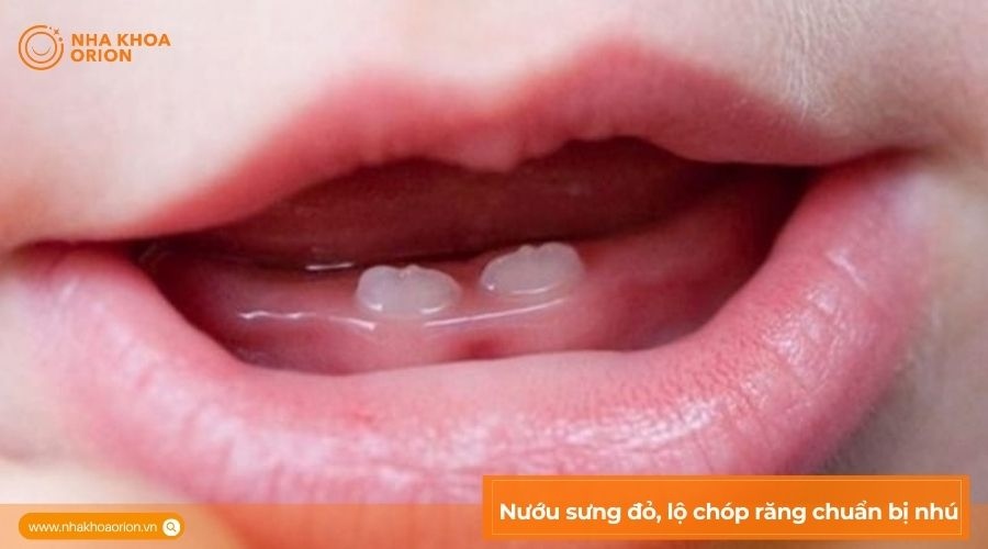 Nướu sưng đỏ, lộ ch&oacute;p răng chuẩn bị nh&uacute;