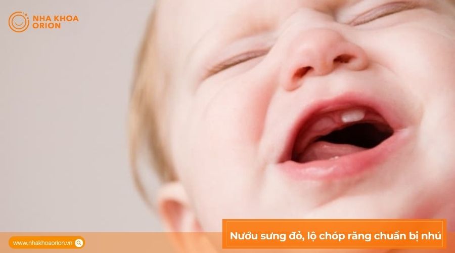 Nướu sưng đỏ, lộ ch&oacute;p răng chuẩn bị nh&uacute;