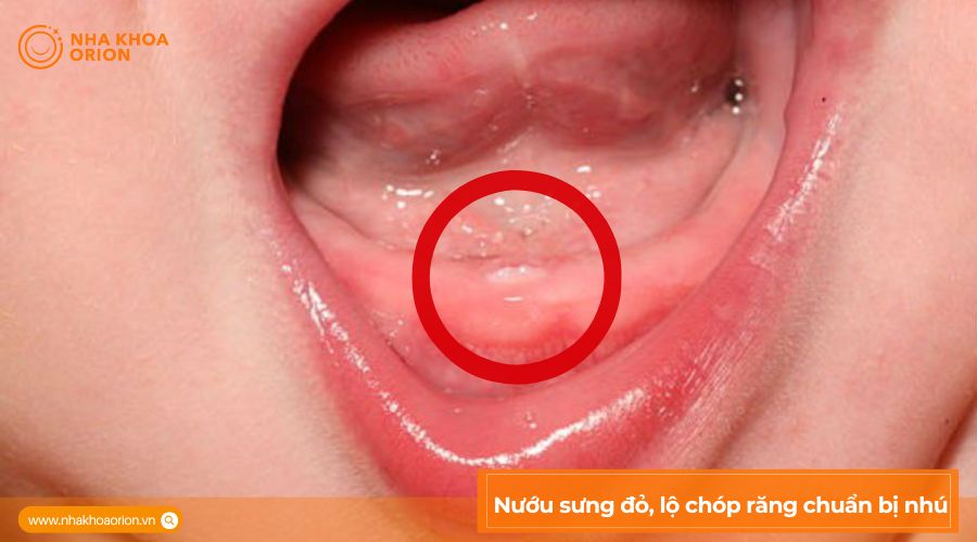 Nướu sưng đỏ, lộ ch&oacute;p răng chuẩn bị nh&uacute;