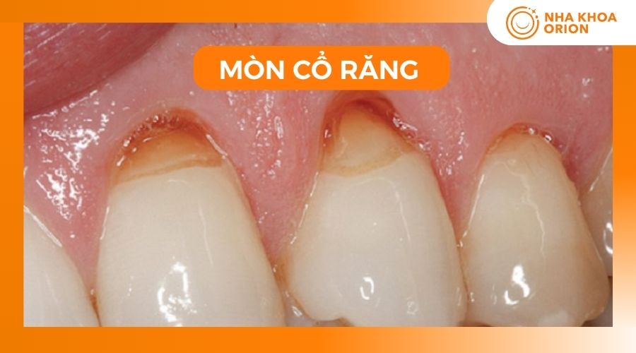 Tình trạng mòn cổ răng do men răng bị bào mòn