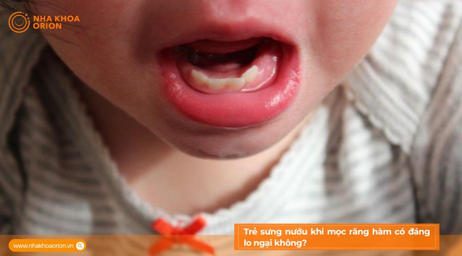 Trẻ sưng nướu khi mọc răng h&agrave;m c&oacute; nguy hiểm kh&ocirc;ng?