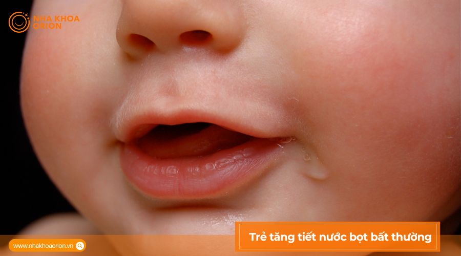 Tăng tiết nước bọt bất thường