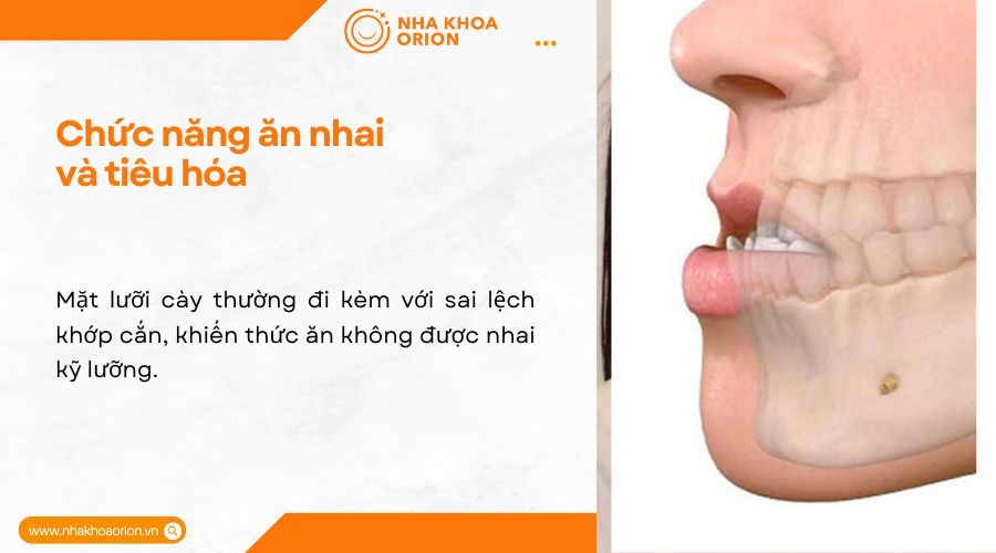 Chức năng ăn nhai v&agrave; ti&ecirc;u h&oacute;a Mặt lưỡi c&agrave;y thường đi k&egrave;m với sai lệch khớp cắn, khiến thức ăn kh&ocirc;ng được nhai kỹ lưỡng. Khi thức ăn chưa được nghiền nhỏ, qu&aacute; tr&igrave;nh ti&ecirc;u h&oacute;a sẽ k&eacute;m hiệu quả, dẫn đến nguy cơ đầy bụng, kh&oacute; ti&ecirc;u, lo&eacute;t dạ d&agrave;y. Ngo&agrave;i ra, sai lệch khớp cắn c&ograve;n l&agrave;m tăng &aacute;p lực l&ecirc;n răng, dẫn đến m&ograve;n men răng, dễ g&atilde;y hoặc lung lay, vi&ecirc;m nướu v&agrave; c&aacute;c vấn đề nha chu kh&aacute;c.&nbsp;    Mặt lưỡi c&agrave;y c&oacute; thể g&acirc;y ảnh hưởng đến chức năng ăn nhai v&agrave; ti&ecirc;u h&oacute;a do sai lệch khớp cắn