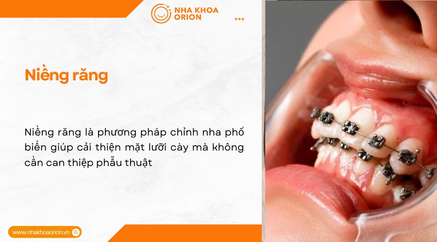 Niềng răng cải thiện mặt lưỡi c&agrave;y