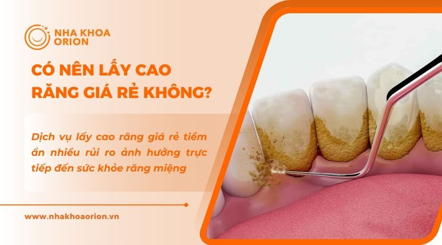 Bạn n&ecirc;n chọn dịch vụ lấy cao răng chất lượng, uy t&iacute;n