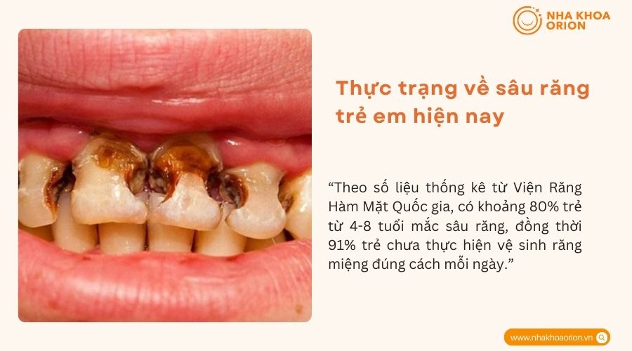 Thực trạng về sâu răng trẻ em hiện nay