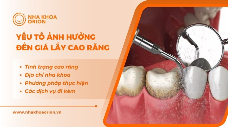 Những yếu tố ảnh hưởng đến gi&aacute; lấy cao răng