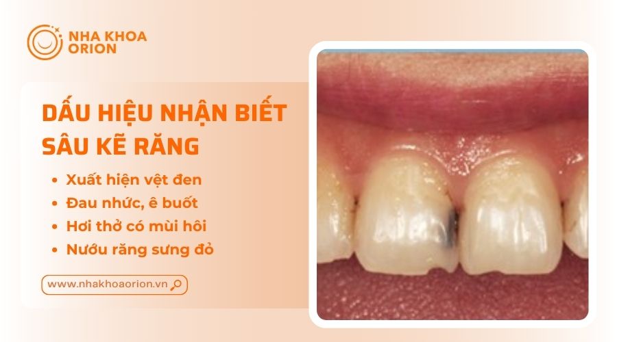 Vết đen l&agrave; dấu hiệu dễ thấy nhất của s&acirc;u kẽ răng