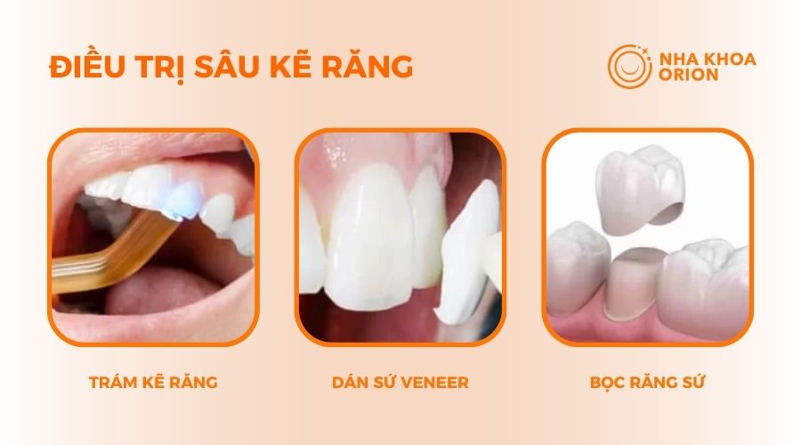 3 c&aacute;ch hữu hiệu điều trị s&acirc;u kẽ răng dứt điểm