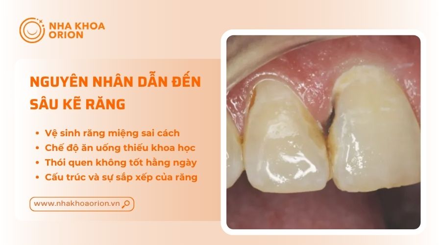 Nguy&ecirc;n nh&acirc;n thường gặp nhất g&acirc;y ra s&acirc;u kẽ răng l&agrave; do chưa vệ sinh răng miệng đ&uacute;ng c&aacute;ch