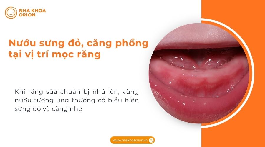 Nướu sưng đỏ, căng phồng tại vị tr&iacute; mọc răng