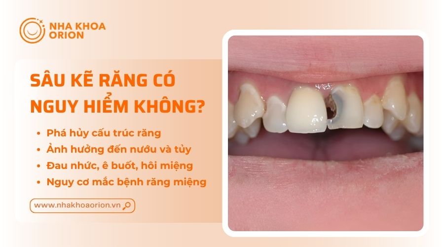 S&acirc;u kẽ răng c&oacute; thể g&acirc;y nguy hiểm cho sức khỏe răng miệng