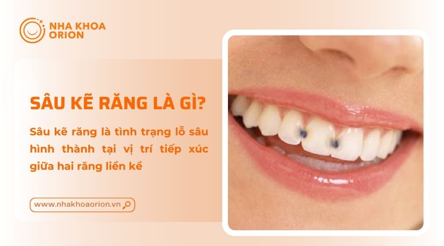 T&igrave;m hiểu s&acirc;u kẽ răng l&agrave; g&igrave;