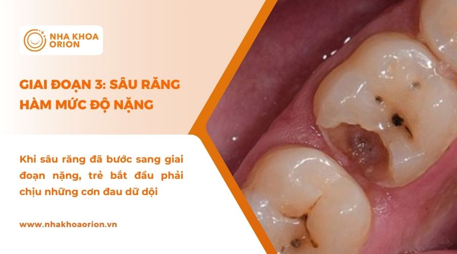 H&igrave;nh ảnh giai đoạn răng s&acirc;u nặng ở trẻ em