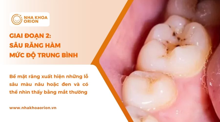 Giai đoạn đầu khi răng s&acirc;u nhẹ