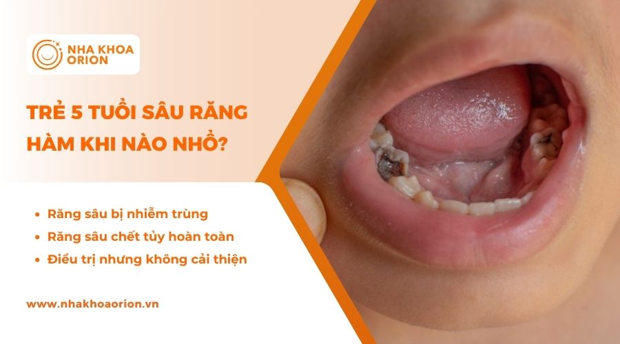 Trẻ 5 tuổi s&acirc;u răng h&agrave;m nặng, nhiễm tr&ugrave;ng c&oacute; thể sẽ phải nhổ răng để điều trị
