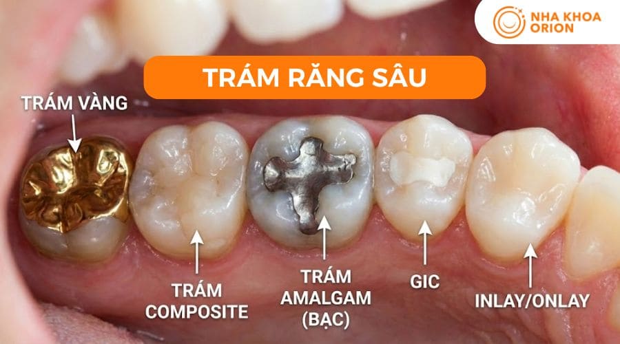 Tr&aacute;m răng gi&uacute;p ngăn t&igrave;nh trạng s&acirc;u trở n&ecirc;n nặng nề