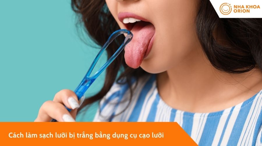 C&aacute;ch l&agrave;m sạch lưỡi bị trắng bằng đồ cạo lưỡi