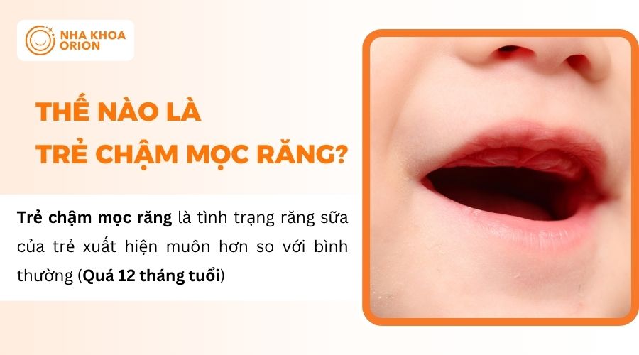 Trẻ chậm mọc răng khi đ&atilde; qu&aacute; 12 th&aacute;ng tuổi