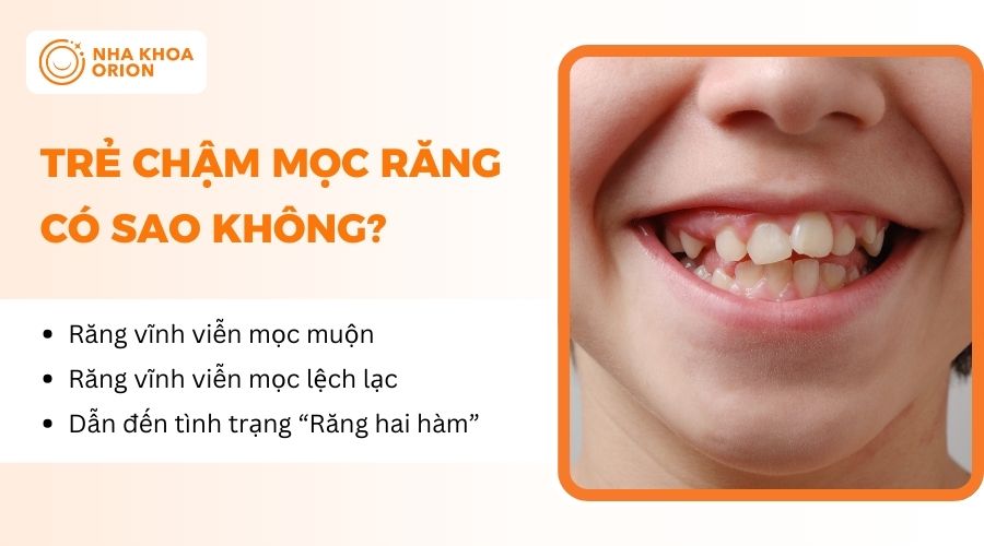 Trẻ chậm mọc răng c&oacute; thể g&acirc;y ảnh hưởng đến qu&aacute; tr&igrave;nh mọc răng vĩnh viễn