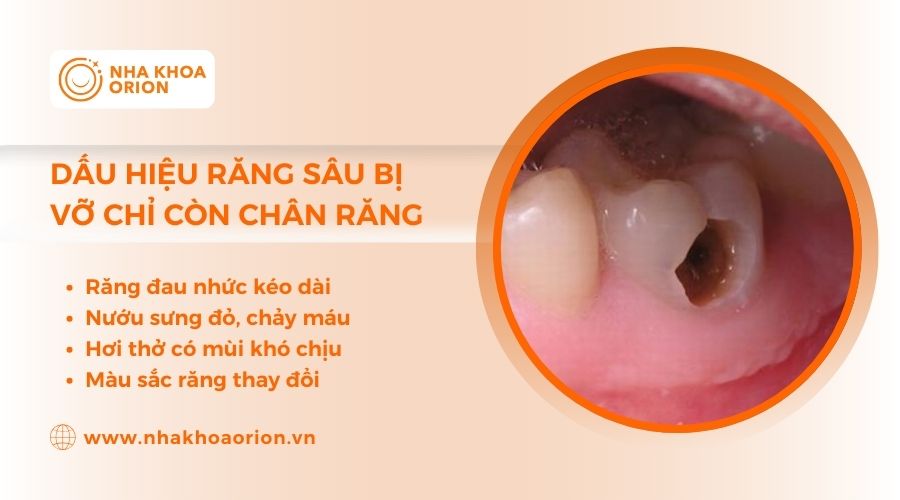 Dấu hiệu nhận biết răng bị s&acirc;u c&oacute; lỗ