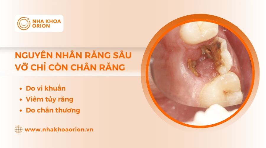 Nguy&ecirc;n nh&acirc;n l&agrave;m răng s&acirc;u bị vỡ chỉ c&ograve;n ch&acirc;n răng