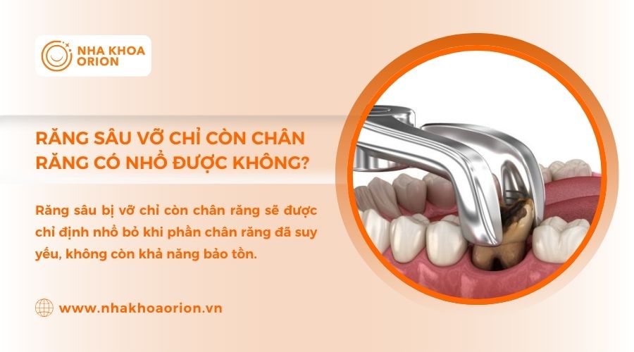 Trường hợp ch&acirc;n răng yếu sẽ phải nhổ răng