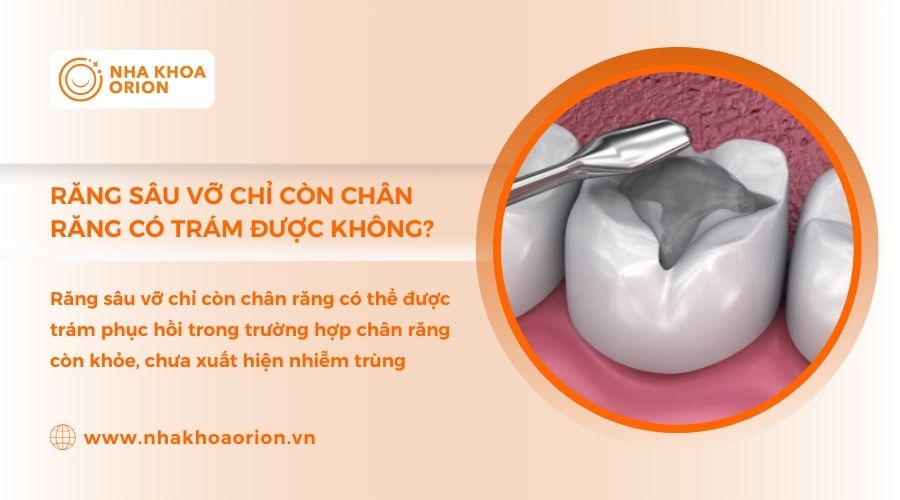 Răng s&acirc;u bị vỡ chỉ c&ograve;n ch&acirc;n răng c&oacute; thể tr&aacute;m nếu ch&acirc;n răng khỏe