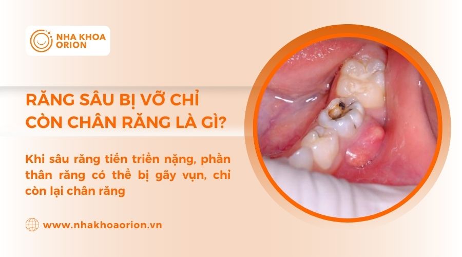 Tổng quan t&igrave;nh trạng răng s&acirc;u bị vỡ chỉ c&ograve;n ch&acirc;n răng
