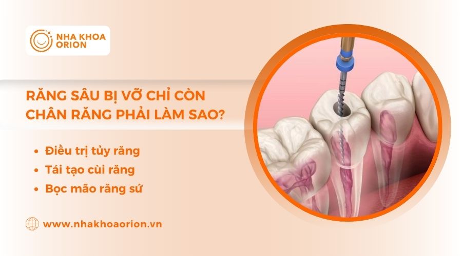 T&igrave;m hiểu răng s&acirc;u bị vỡ chỉ c&ograve;n ch&acirc;n răng phải l&agrave;m sao