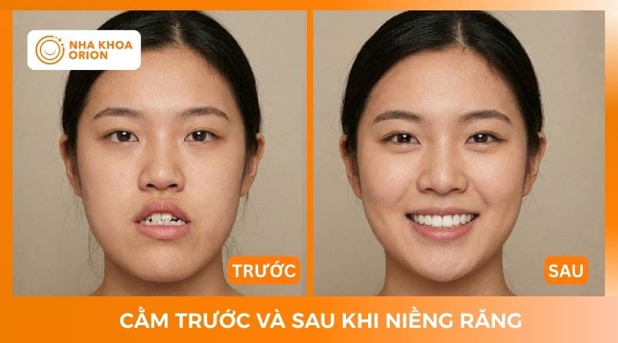 Cằm trước v&agrave; sau khi niềng răng