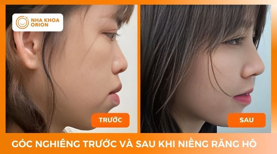 H&igrave;nh ảnh g&oacute;c nghi&ecirc;ng sau khi niềng răng h&ocirc;