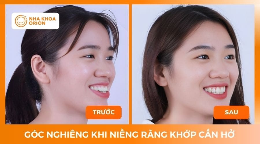 G&oacute;c nghi&ecirc;ng sau khi niềng răng khớp cắn hở