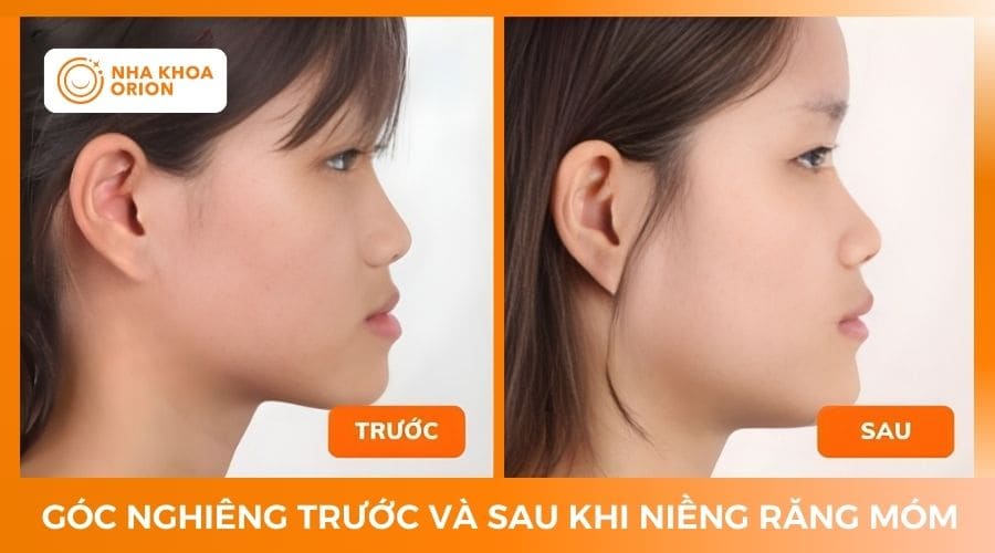 G&oacute;c nghi&ecirc;ng trước v&agrave; sau khi niềng răng h&ocirc;