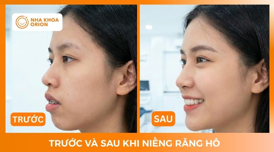 Khu&ocirc;n mặt thay đổi r&otilde; rệt khi niềng răng h&ocirc;
