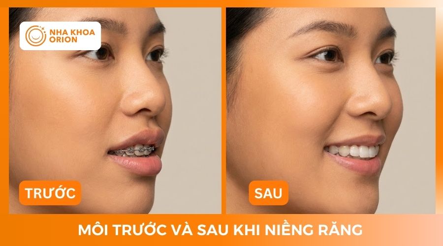 M&ocirc;i trước v&agrave; sau khi niềng răng