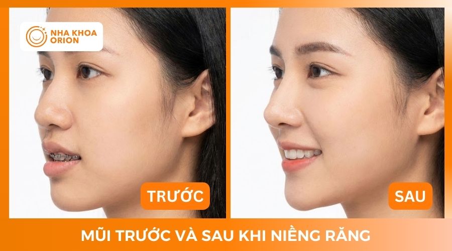 Mũi trước v&agrave; sau khi niềng răng