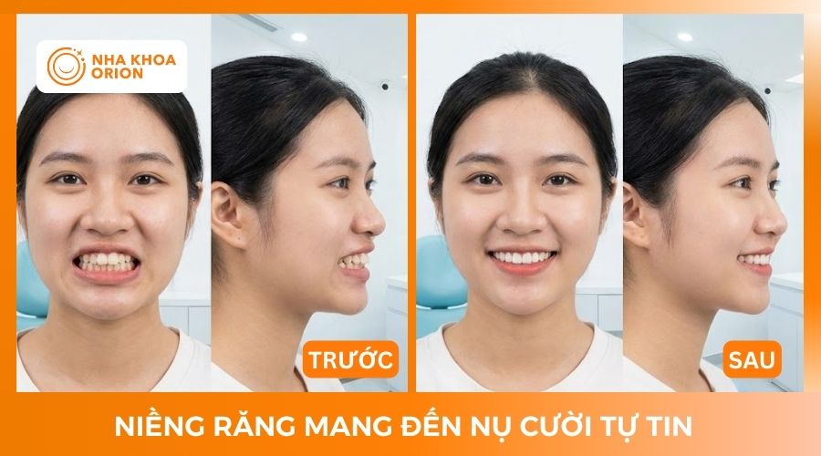 Niềng răng gi&uacute;p khu&ocirc;n mặt thon v&agrave; c&acirc;n đối hơn