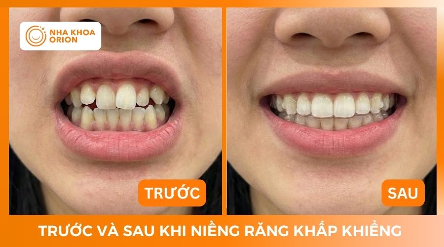 Lấy lại nụ cười tự tin sau khi niềng răng khấp khiểng