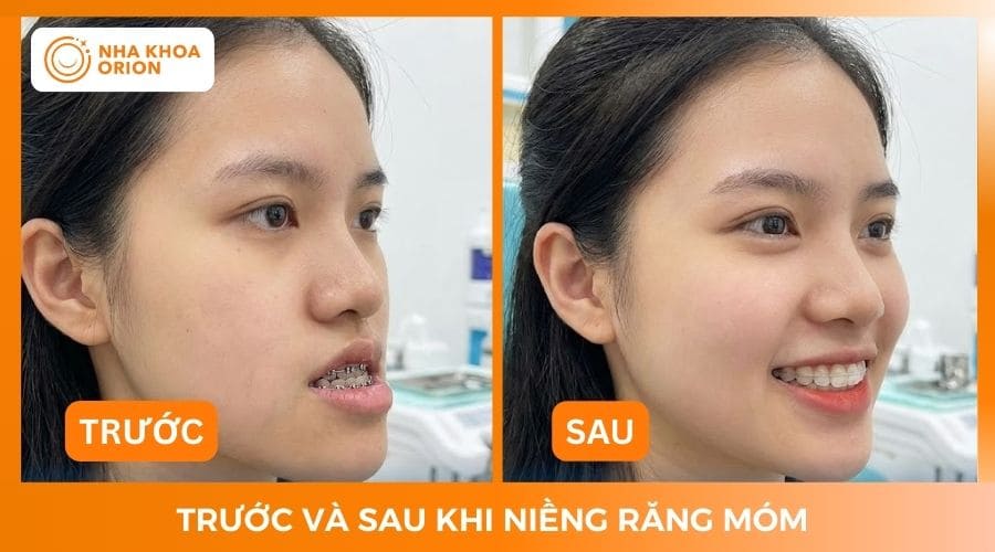 Khu&ocirc;n mặt sau khi niềng răng m&oacute;m trở n&ecirc;n h&agrave;i h&ograve;a hơn