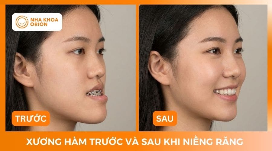 Xương h&agrave;m trước v&agrave; sau khi niềng răng