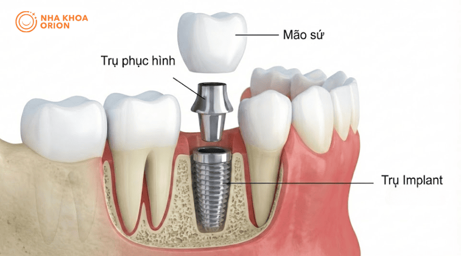 Tìm hiểu trồng răng Implant là gì
