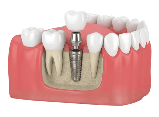 Cấy ghép Implant