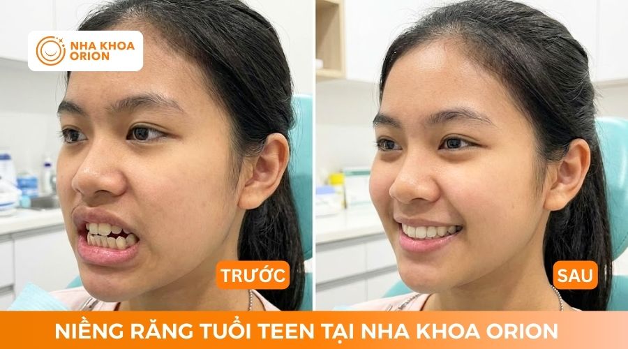 Niềng răng cho tuổi teen gi&uacute;p mang đến nụ cười tự tin cho trẻ