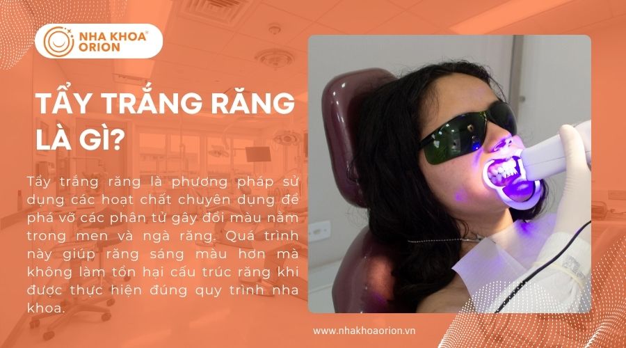 Tẩy trắng răng là gì?