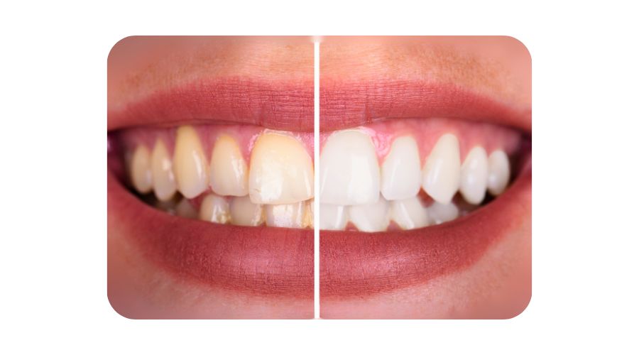 Những trường hợp nên tẩy trắng răng