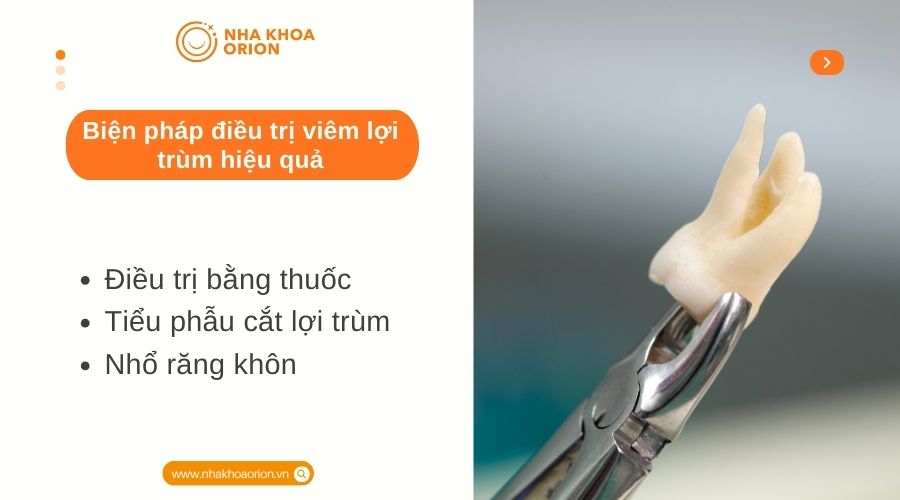 Biện ph&aacute;p điều trị vi&ecirc;m lợi tr&ugrave;m hiệu quả