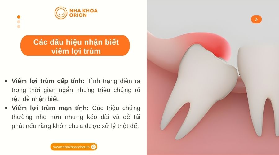 C&aacute;c dấu hiệu nhận biết vi&ecirc;m lợi tr&ugrave;m